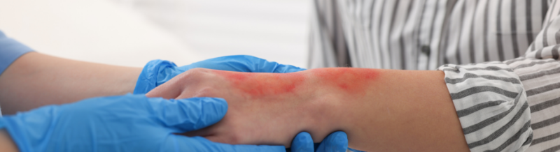 Understanding the Four Elements of Negligence in Burn Injury Lawsuits