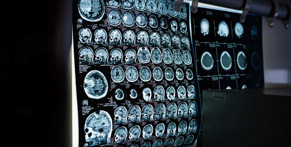 Understanding Infant Brain Damage: Causes, Consequences, and Legal Implications