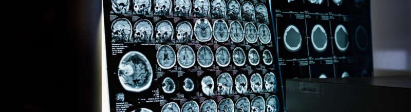 Understanding Infant Brain Damage: Causes, Consequences, and Legal Implications
