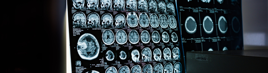 Understanding Infant Brain Damage: Causes, Consequences, and Legal Implications
