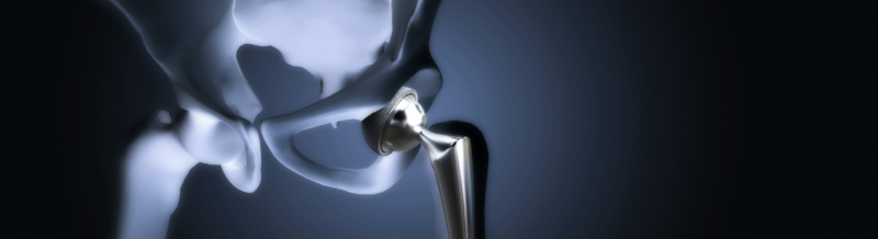 Synovo Hip Replacement Lawsuits