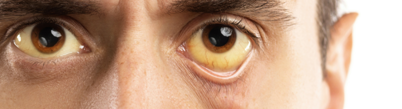Understanding Eye Problems Caused by Elmiron: Risks, Symptoms, and Legal Implications