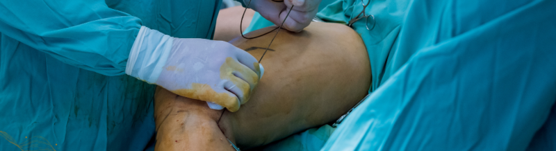 Understanding Anesthesia Injuries: A Comprehensive Guide for Attorneys