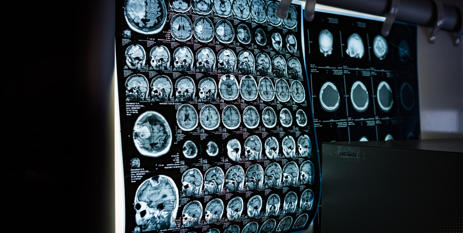 The Importance of Getting an MRI after a Car Accident: A Comprehensive Guide
