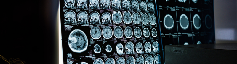 The Importance of Getting an MRI after a Car Accident: A Comprehensive Guide