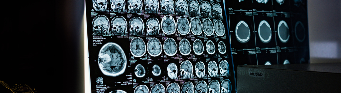 The Importance of Getting an MRI after a Car Accident: A Comprehensive Guide