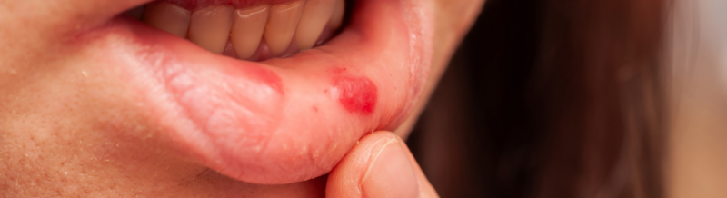 Understanding the 4 Stages of Pressure Ulcers: A Comprehensive Guide